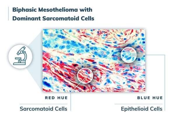 Biphasic mesothelioma with dominant sarcomatoid cells